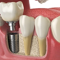 an illustration of a dental implant undergoing osseointegration