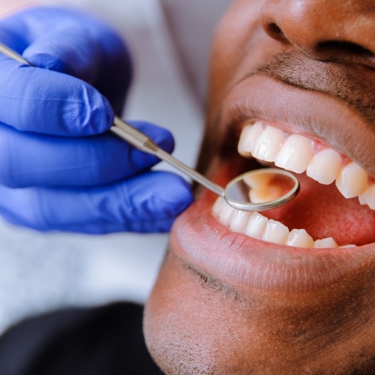 Dentist examining smile after tooth colored filling restoration