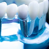 a model of a dental implant bridge