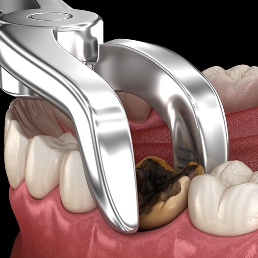 illustration for tooth extractions in Pensacola