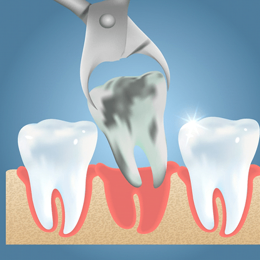 illustration of a tooth extraction