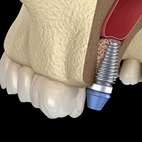 Digital model of dental implant