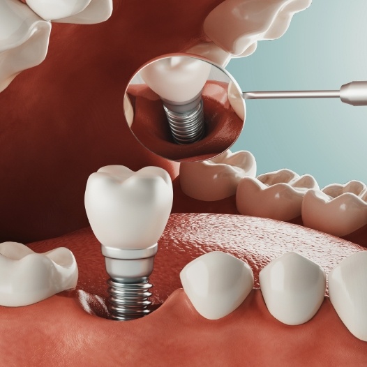 Animated smile with dental implant supported replacement tooth