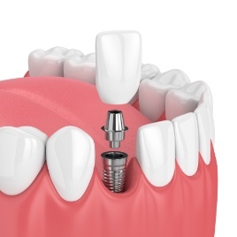 Animated smile during dental implant supported dental crown placement