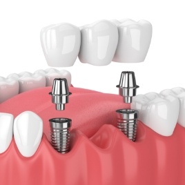 Animated smile during dental implant supported fixed bridge placement