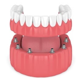 Animated smile during dental implant supported denture placement