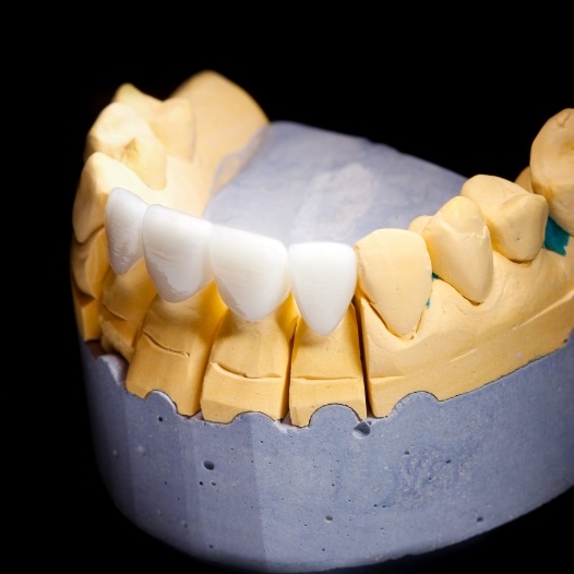 Model smile with dental bridge restoration