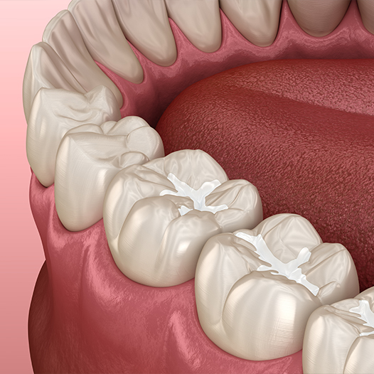 Clear mouthguard on metal tray