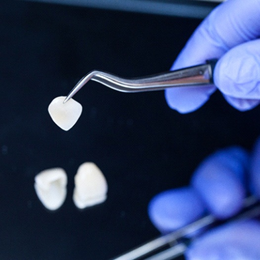 Dentist holding veneer in Pensacola with tweezers