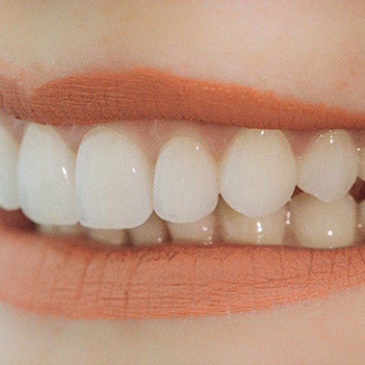 Closeup of woman smiling with veneers in Pensacola