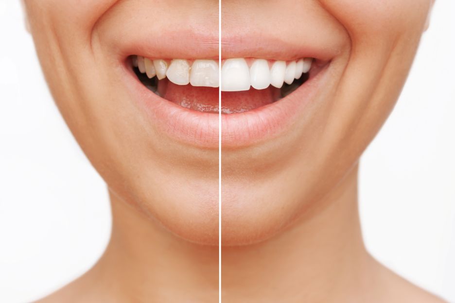A before and after photo of a woman with veneers.